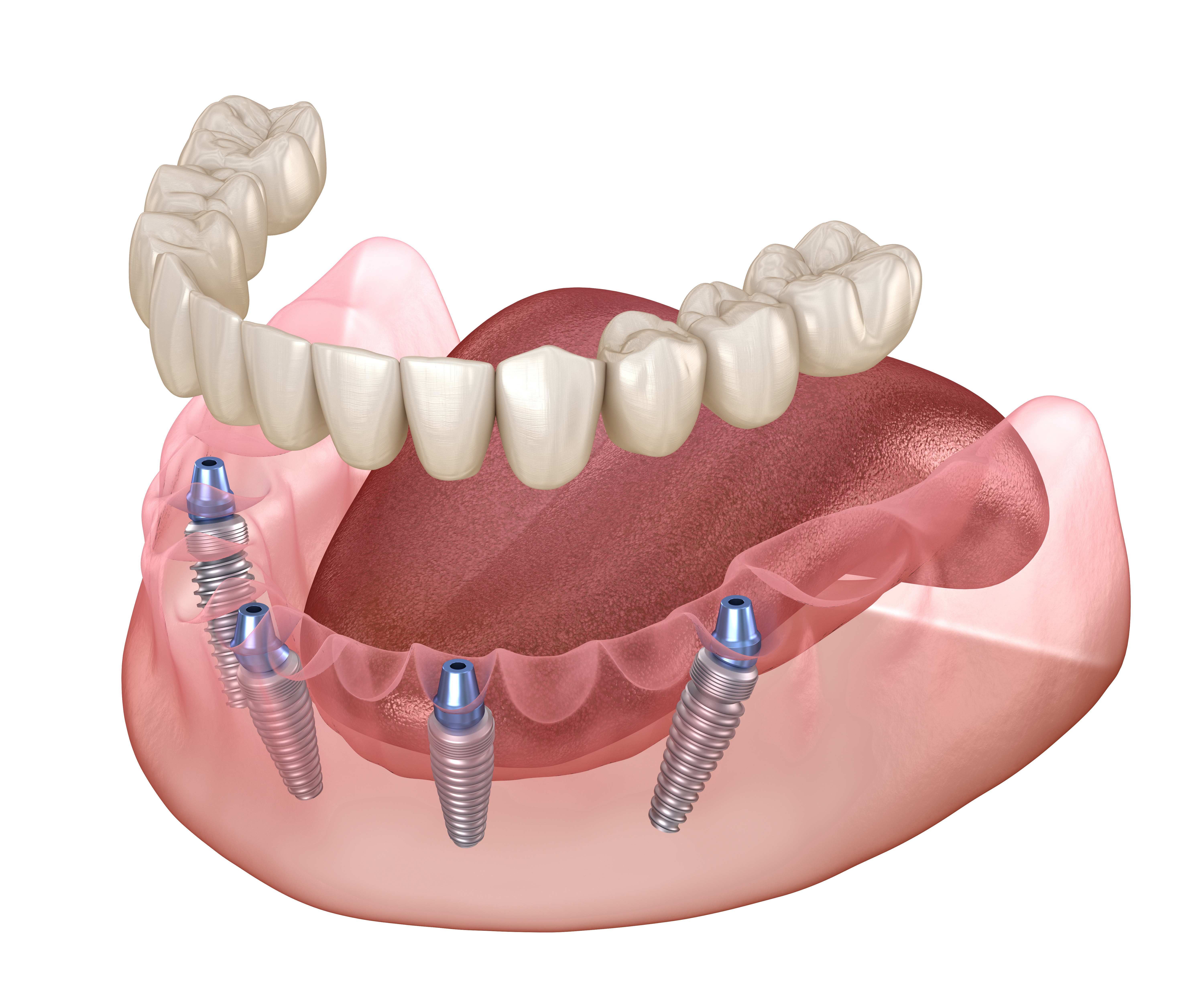 Dentures at Integrity Dental Group