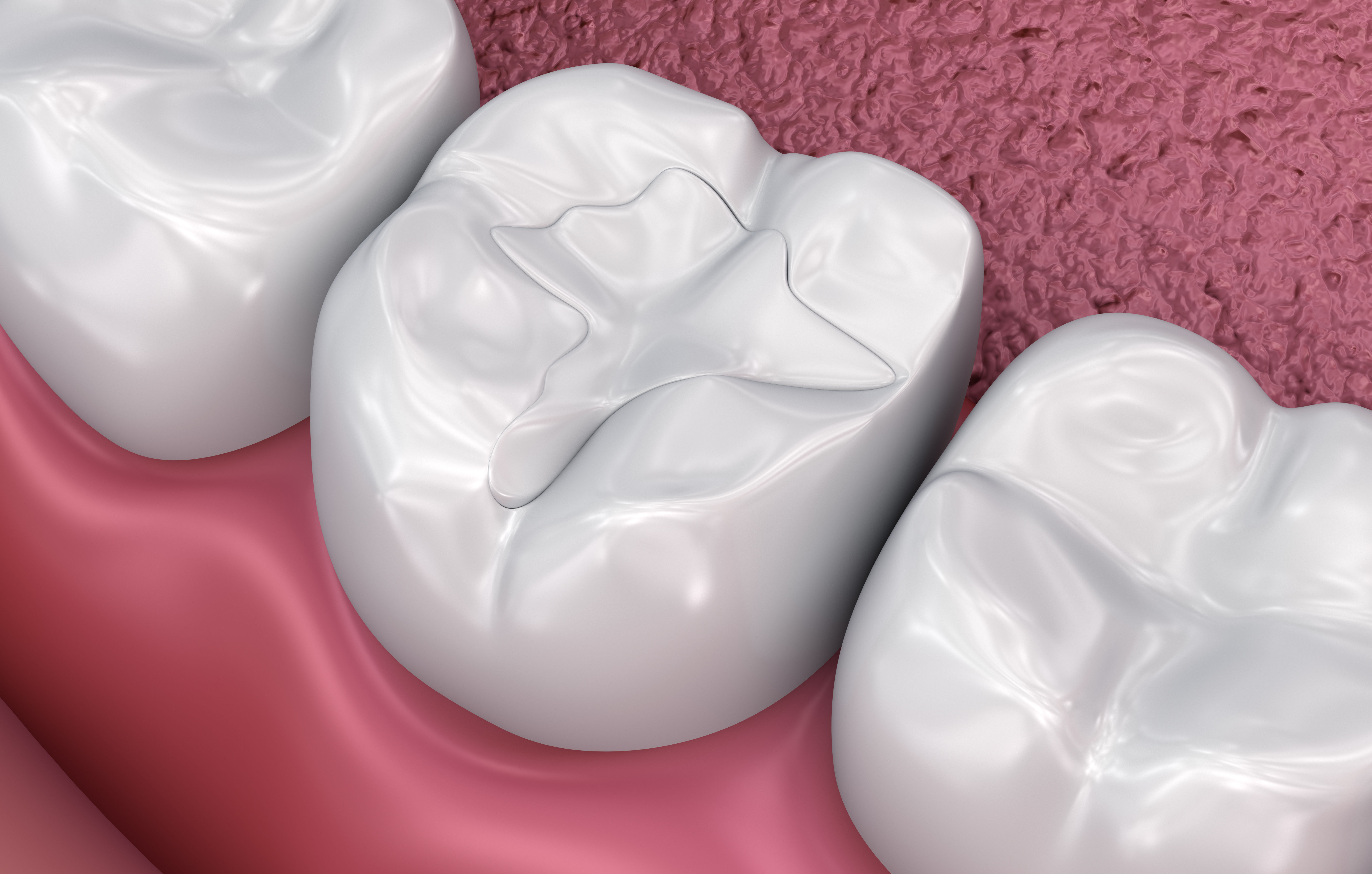 Why You May Still Get Cavities Even With Fluoride Treatment