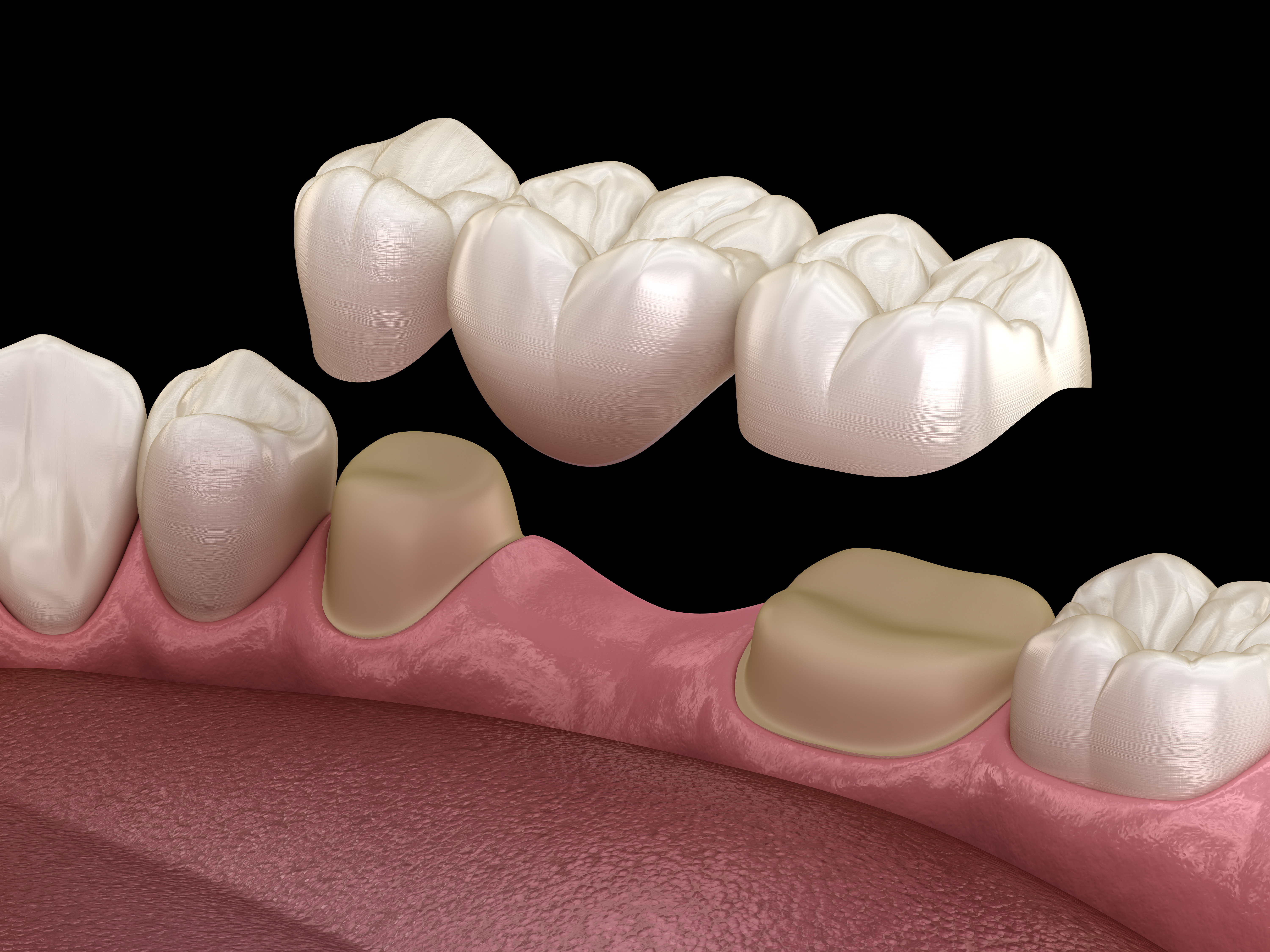 Dental Bridges at Integrity Dental Group