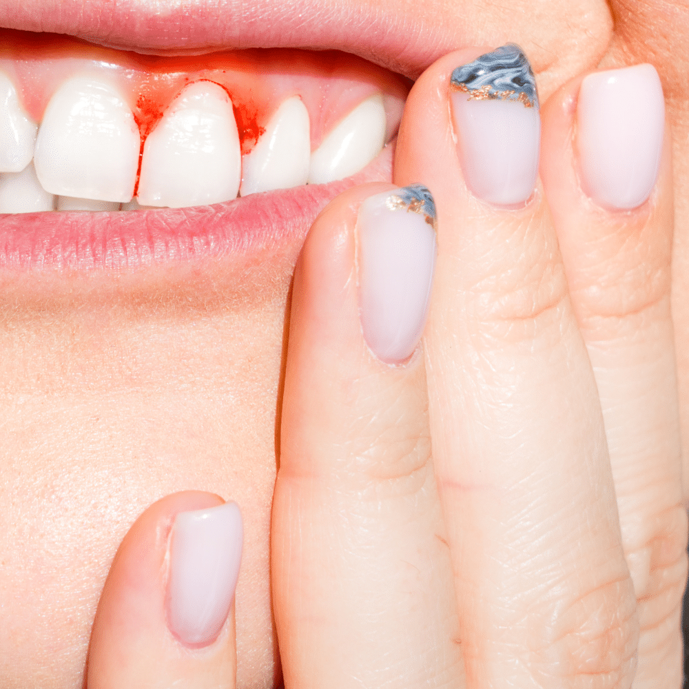 Woman showing signs of gum disease