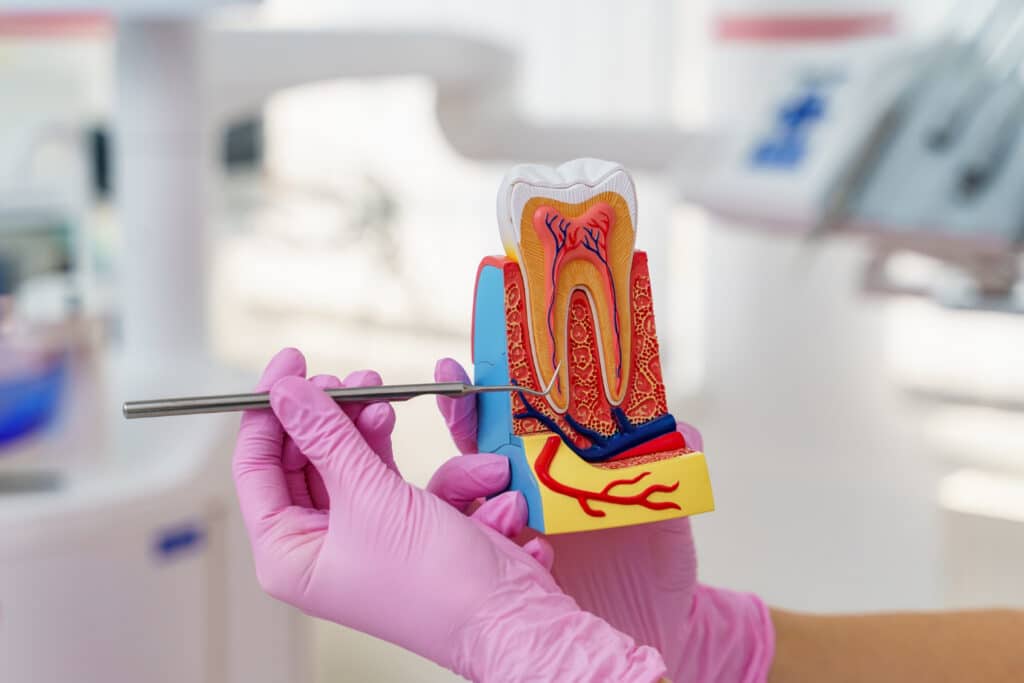 root canal